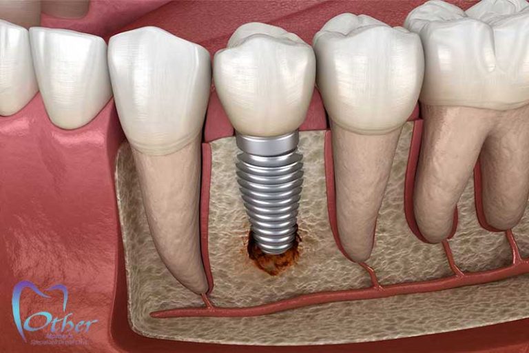 چرا ایمپلنت دیجیتال را به ایمپلنت معمولی ترجیح دهیم؟