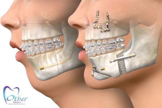 همه چیز دربارۀ جراحی فک و صورت
